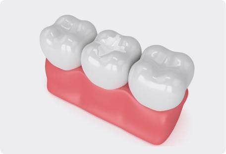 dental sealants visualization