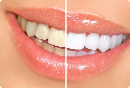 Before and after photo of teeth whitening