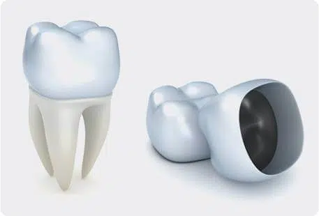 Dental crowns in Dayspring Dental, NJ